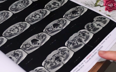 Cirurgias eletivas de ortopedia crescem mais de 135% e transformam vidas em Santa Catarina